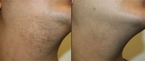 laser hair removal chin and neck